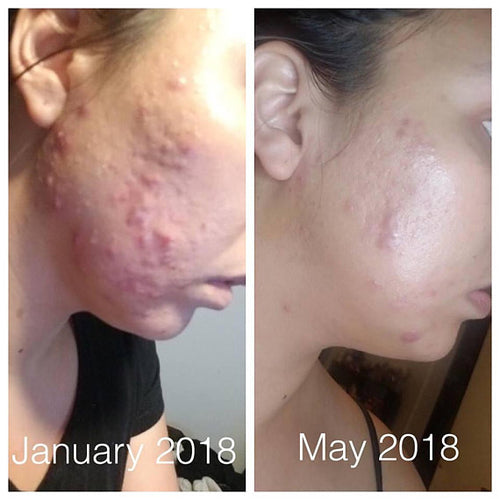 Super Organic Acne Treatment
