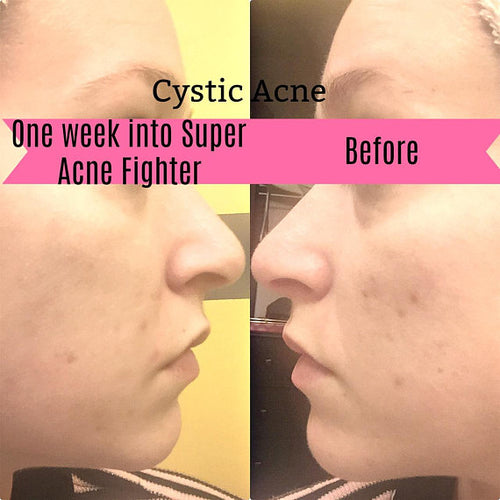 Super Organic Acne Treatment